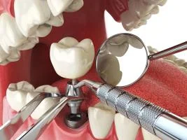 Illustration of a single dental implant