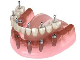Illustration of a full-arch implant restoration
