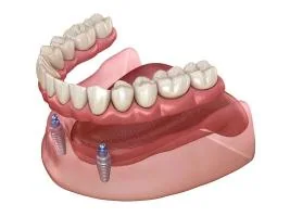 Illustration of an implant-supported overdenture