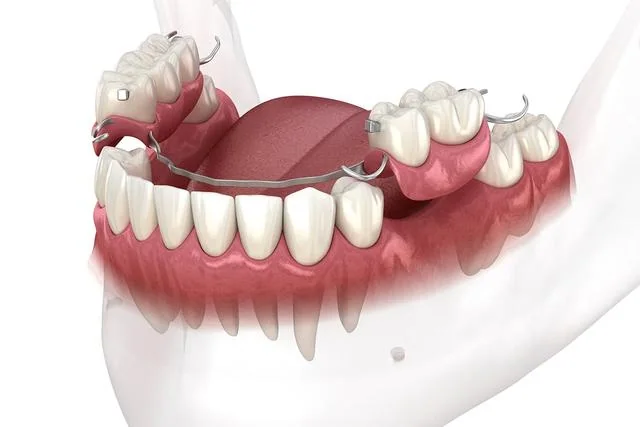 Illustration of a removable partial denture