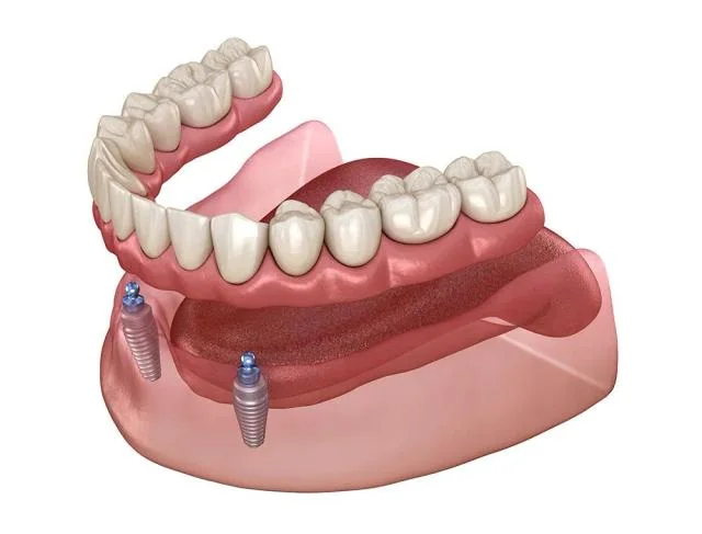 Illustration of a snap-in implant denture
