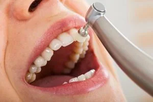 Dental hygienist polishing a patient's teeth