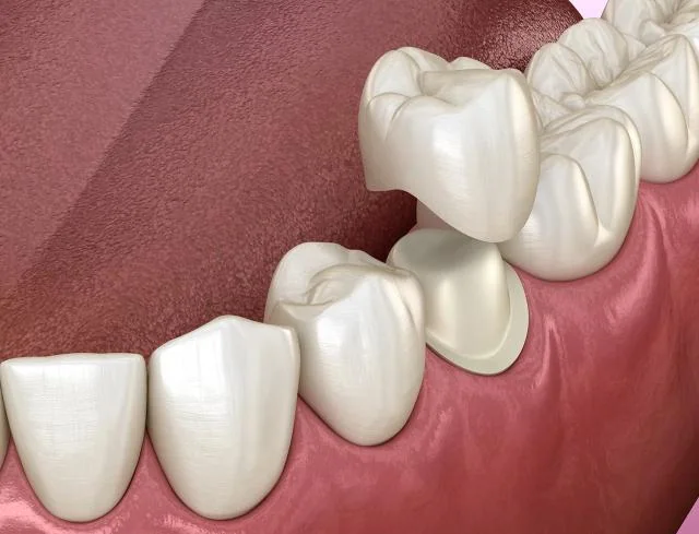 Digital illustration of a dental crown restoration